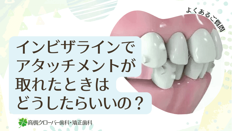 インビザラインでアタッチメントが取れたときはどうしたらいいの？